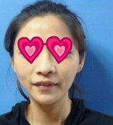 济南鹏爱美容整形医院Misko隆鼻闺蜜都说我的颜值大增