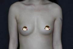 婚后哺乳导致胸平多亏假体隆胸让我重回性感