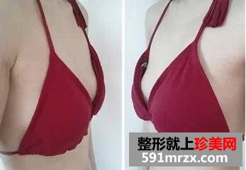 230cc,假体,形态,手感