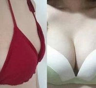 230cc的假体形态和手感都很好
