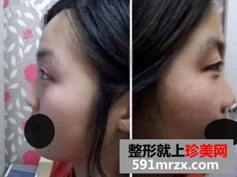 双眼皮与隆鼻前后对比图参考