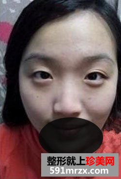 双眼皮与隆鼻前后对比图参考