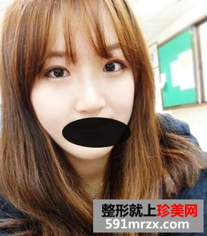 双眼皮与隆鼻前后对比图参考