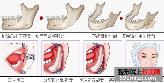 下颌角整形案例
