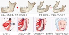 超真实和详细MM分享下颌角整形案例