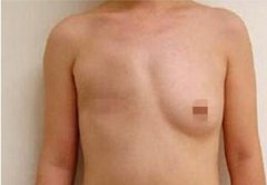 大龄剩女患癌失乳千里赴深再造“事业线”