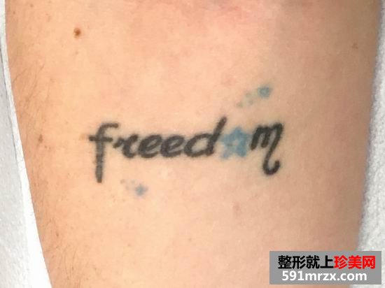 皮秒,激光,洗纹身,效果,妹子,真实,经历