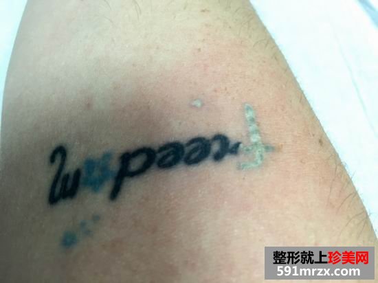 皮秒,激光,洗纹身,效果,妹子,真实,经历
