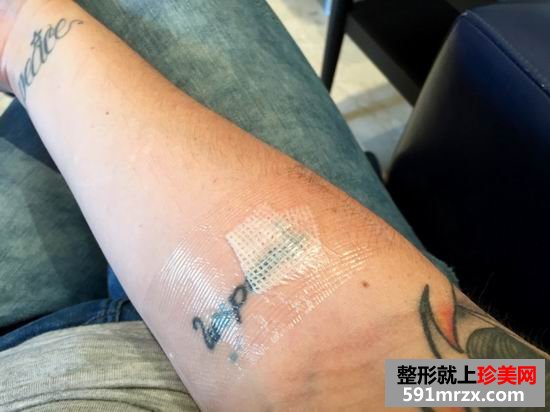 皮秒,激光,洗纹身,效果,妹子,真实,经历
