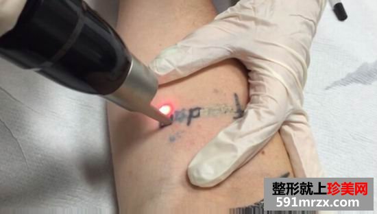 皮秒,激光,洗纹身,效果,妹子,真实,经历