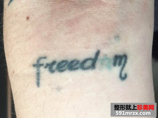 皮秒,激光,洗纹身,效果,妹子,真实,经历
