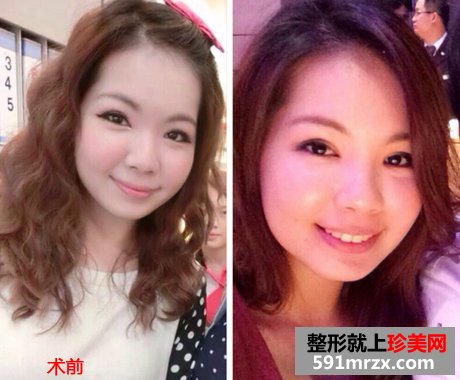 割双眼皮术前术后对比图