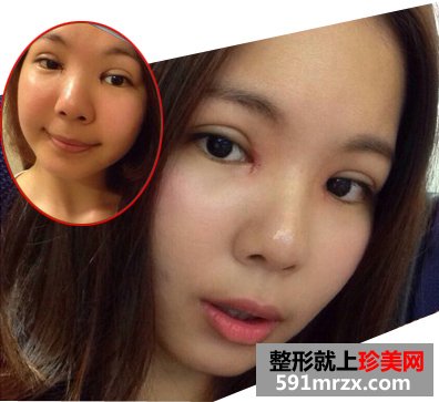 割双眼皮手术图片(术后一周)