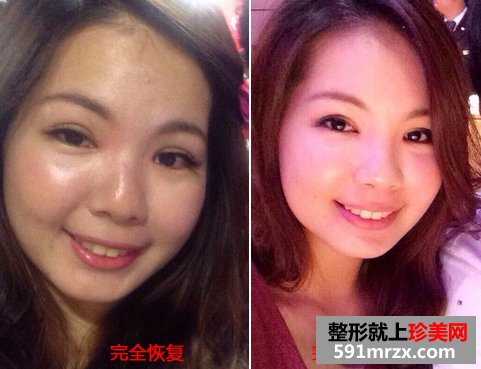 割双眼皮手术图片(完全恢复)