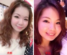 我去割双眼皮啦有不少割双眼皮手术图片