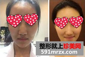 温州,加美,整形,美容,医院,水光注射,素颜,上班