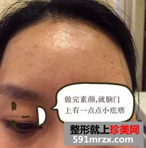 温州,加美,整形,美容,医院,水光注射,素颜,上班