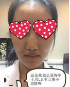温州加美整形美容医院水光注射后我素颜上班毫无压力