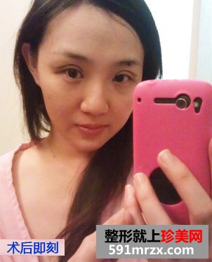 做双眼皮手术恢复时间多长