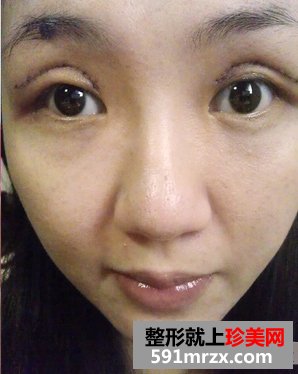 做双眼皮手术恢复时间：第5天