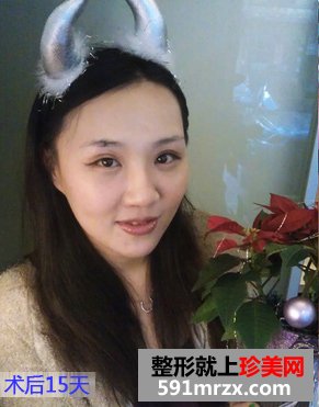 做双眼皮手术恢复时间：第15天