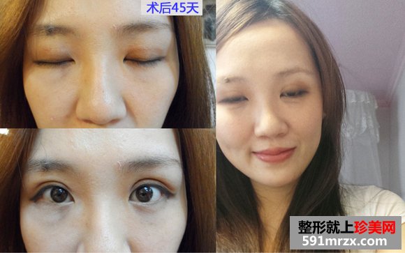 做双眼皮手术恢复时间：第30天
