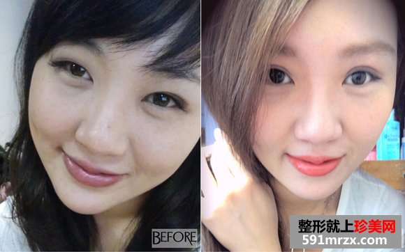 双眼皮手术前后的对比照