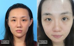做双眼皮手术恢复时间多长网友亲身经历告诉你