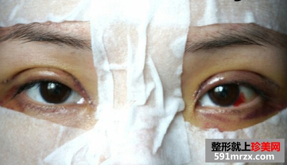 切开双眼皮,消肿
