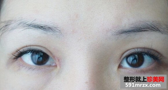 切开双眼皮,消肿
