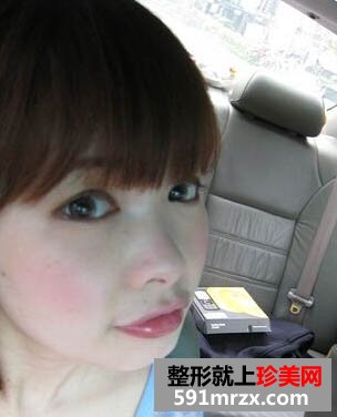 玻尿酸效果好吗？让这位妹子告诉你！
