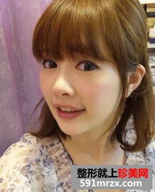 玻尿酸效果好吗？让这位妹子告诉你！