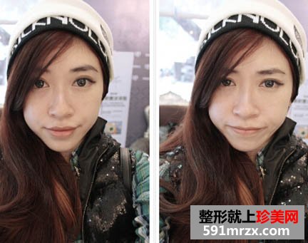 打瘦脸针术前
