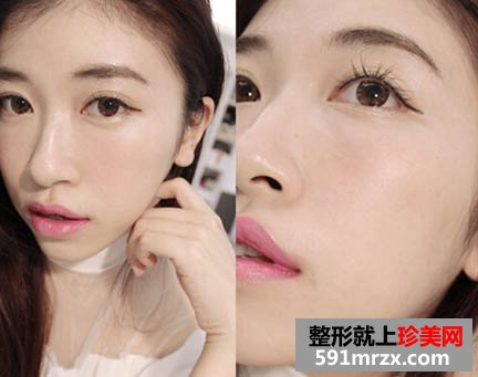 打完瘦脸针后1个月