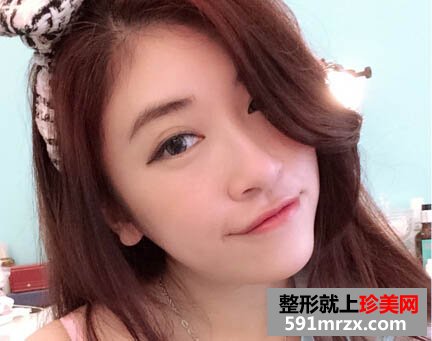 打完瘦脸针2个月