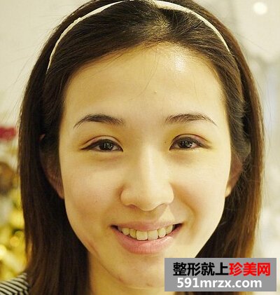 割完双眼皮1周