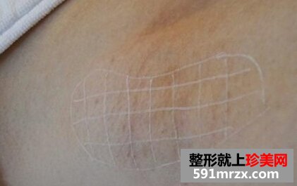 脱腋毛,过程