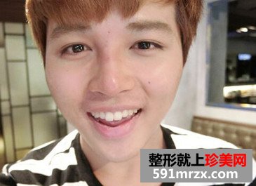 迷恋,玻尿酸,隆鼻,欧巴