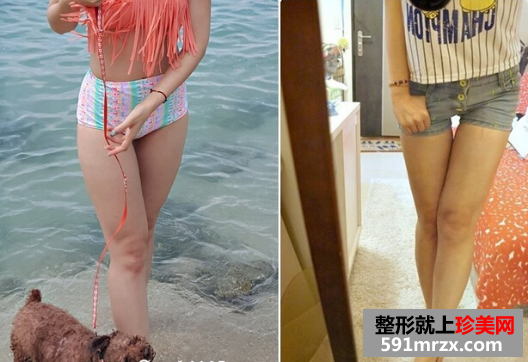 大腿,吸脂,少女,时代,大美腿