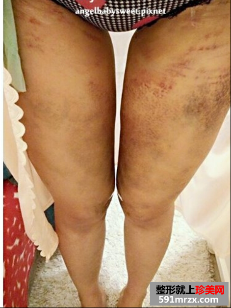 大腿,吸脂,少女,时代,大美腿
