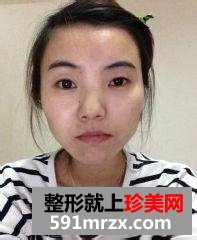 北京开内眼角,硅胶隆鼻前后对比