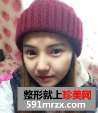 北京开内眼角,硅胶隆鼻前后对比