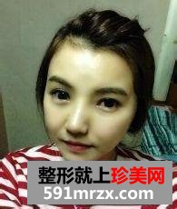 北京开内眼角,硅胶隆鼻前后对比