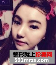北京开内眼角,硅胶隆鼻前后对比