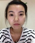 亲看我去北京做的开内眼角手术+硅胶隆鼻前后对比照片