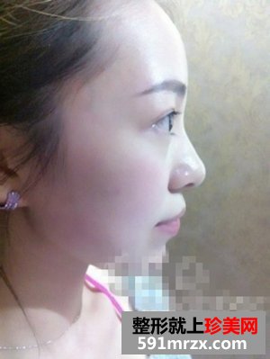 注射玻尿酸隆下巴,瘦脸针保妥适