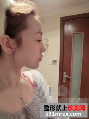 注射玻尿酸隆下巴,瘦脸针保妥适