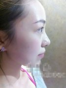 注射玻尿酸隆下巴+注射保妥适瘦脸针瞬间韩国范儿
