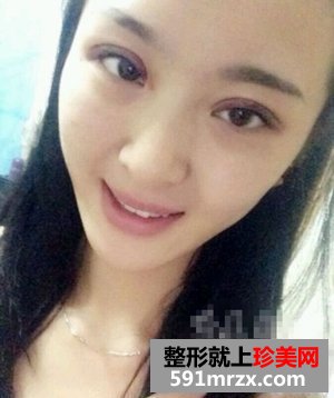 微创双眼皮整形医院