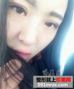 微创双眼皮整形医院